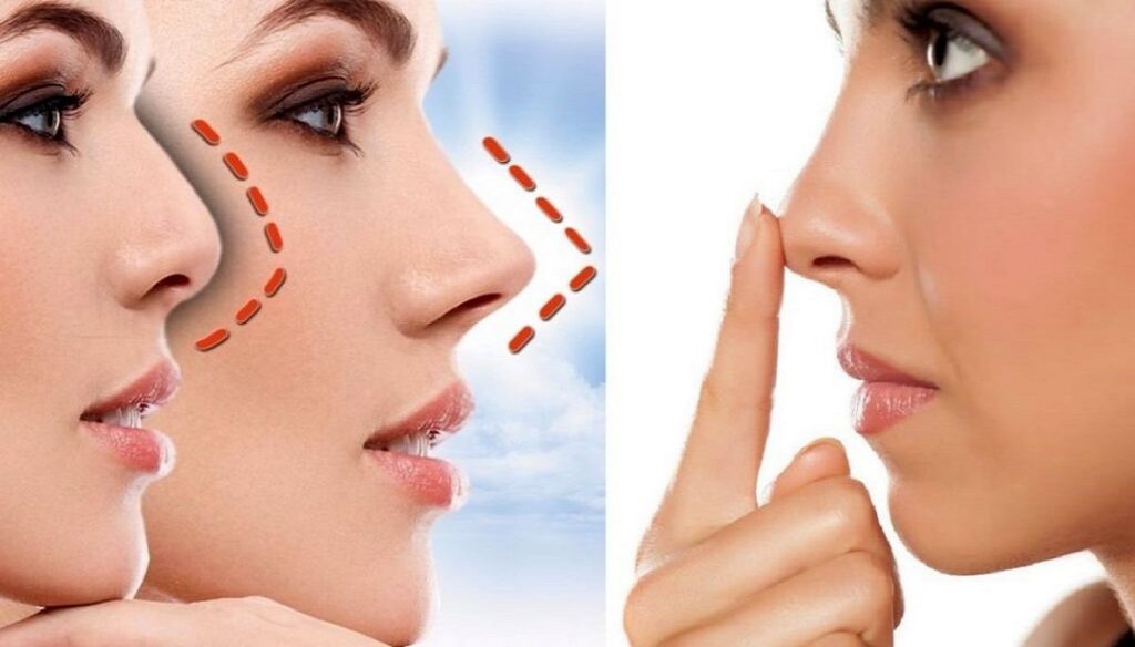 فیلم عمل بینی دختر ۱۶ ساله+فیلم جراحی بینی عروسکی